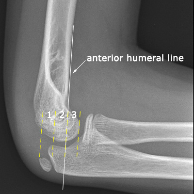 anterior humeral line