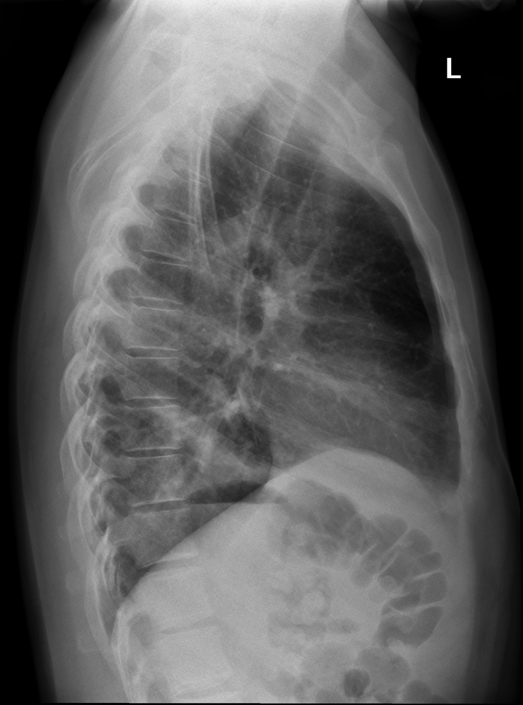 Lateral Chest Case 1 - wikiRadiography
