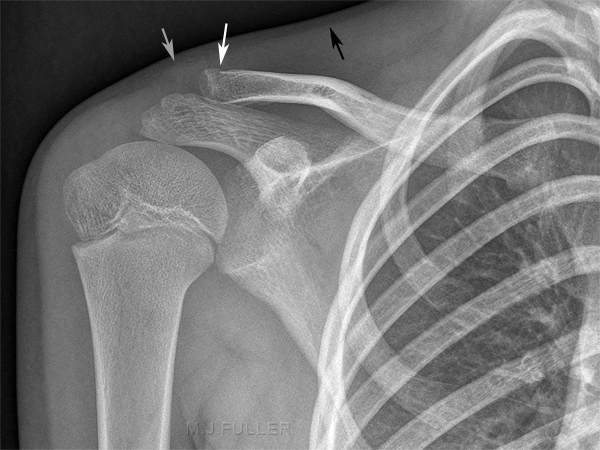 Ap shoulder with Clavicle Fracture