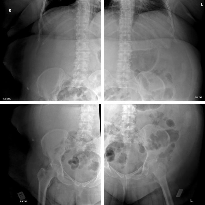 4 quadrant abdominal radiography