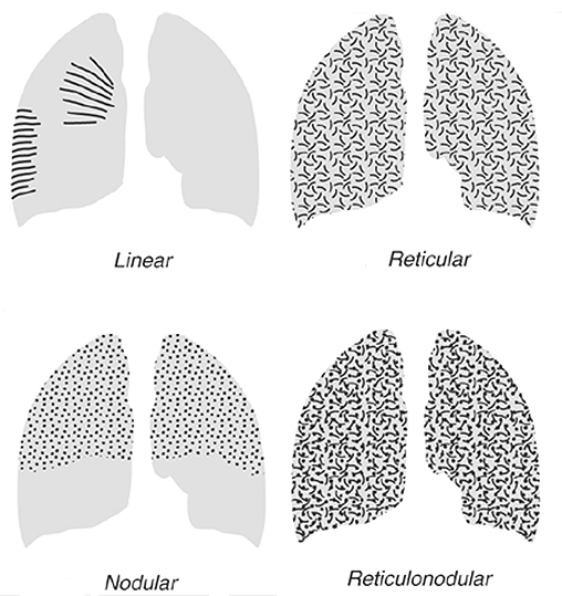 interstitial lung patterns