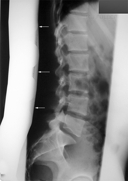 lateral lumbar spine- snake