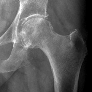 Neck of Femur Fractures - wikiRadiography
