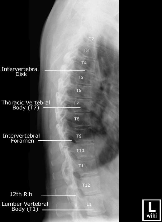 Thoracic Spine radiographic Anatomy - wikiRadiography