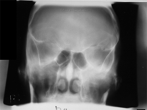 facial bone tomography