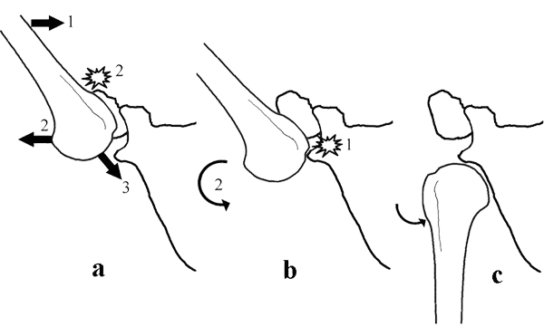 inferior shoulder dislocation mechanism