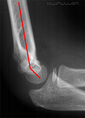 The Paediatric Elbow - wikiRadiography