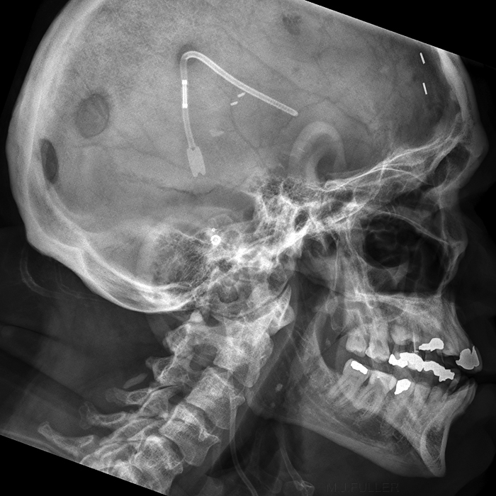 lateral skull