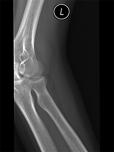 elbow trauma case study 1 oblique elbow