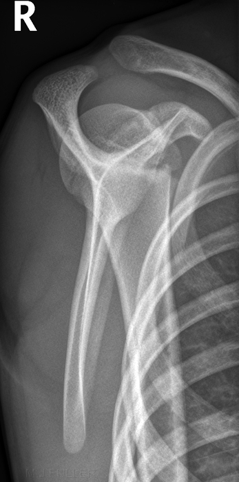 Normal 13 year old male lateral scapula