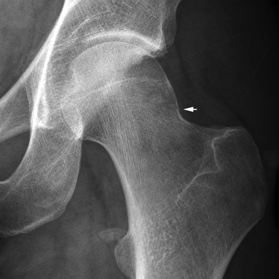 Neck of femur fracture