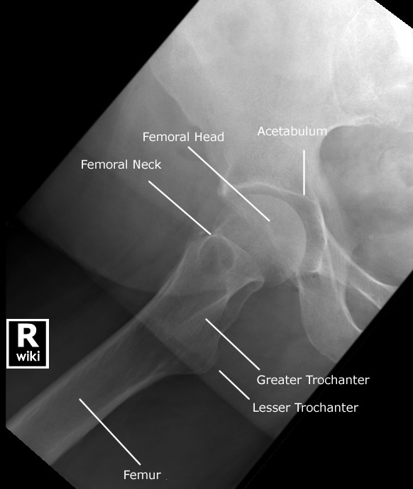Radiographic Anatomy - Hip - Lateral Rolled