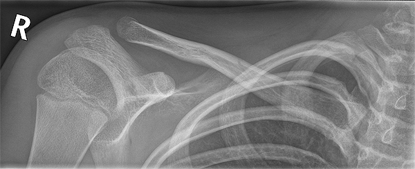 Ap Clavicle with fracture
