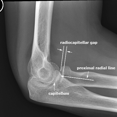lateral elbow