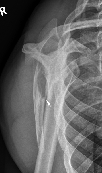 lateral scapula fracture