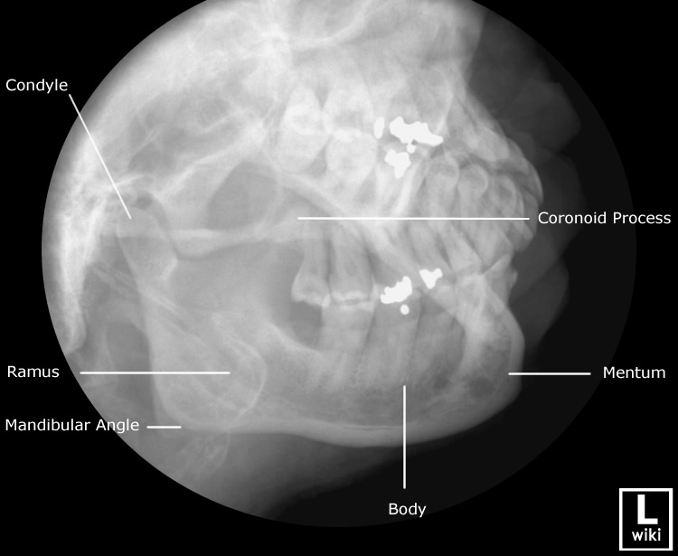 Radiographic Anatomy - Mandible Oblique
