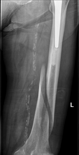 SPIRAL FRACTURE OF THE FEMUR