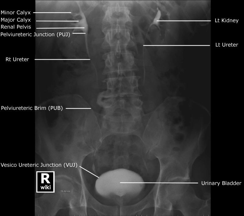 Radiographic Anatomy - Abdomen AP Supine IVP