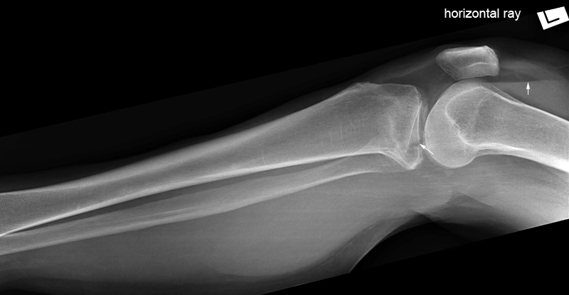 lateral lower leg