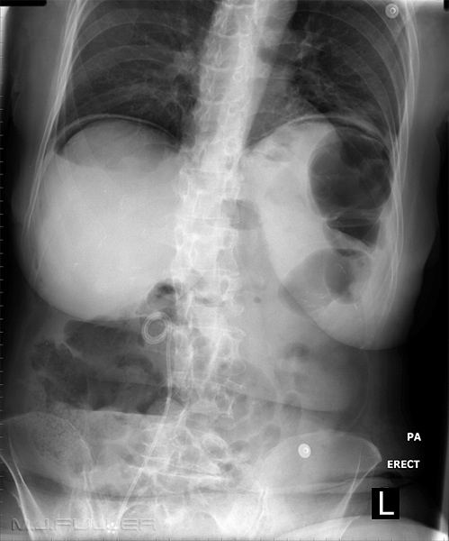 Pneumoperitoneum- Radiographic Techniques - wikiRadiography
