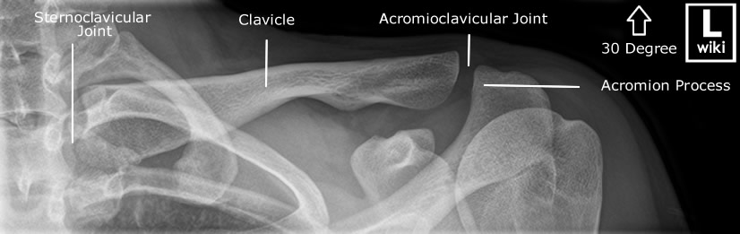 Clavicle Radiographic Anatomy - wikiRadiography