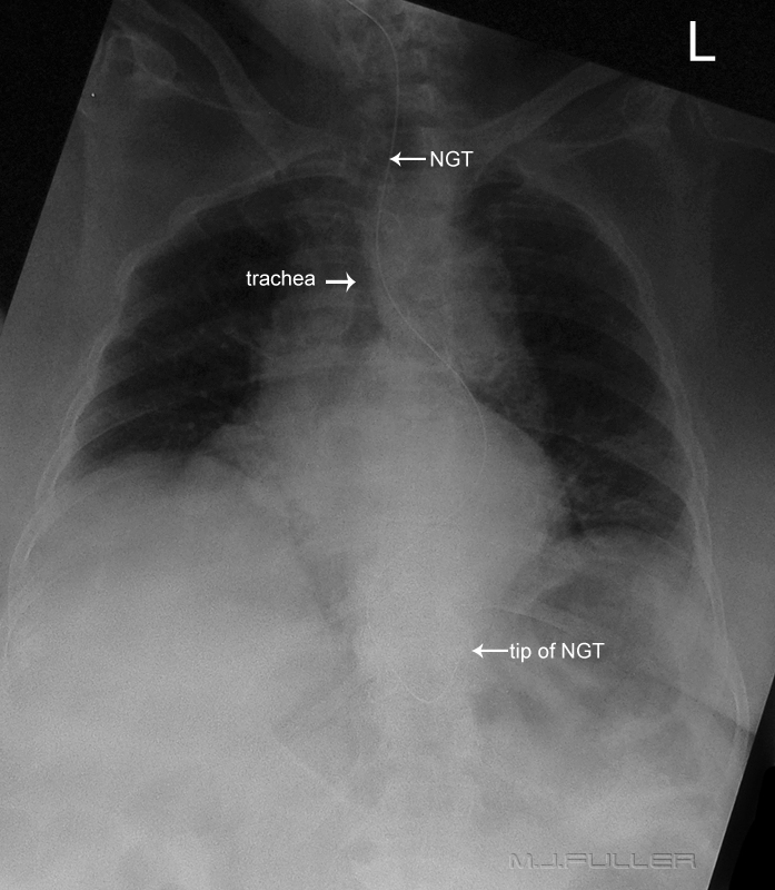 Nasogastric Tube Position Confirmation - wikiRadiography