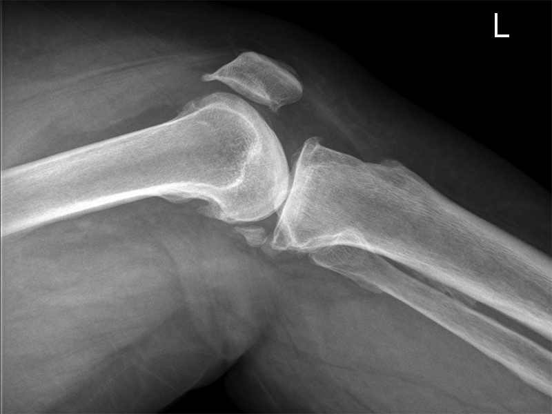 lateral knee