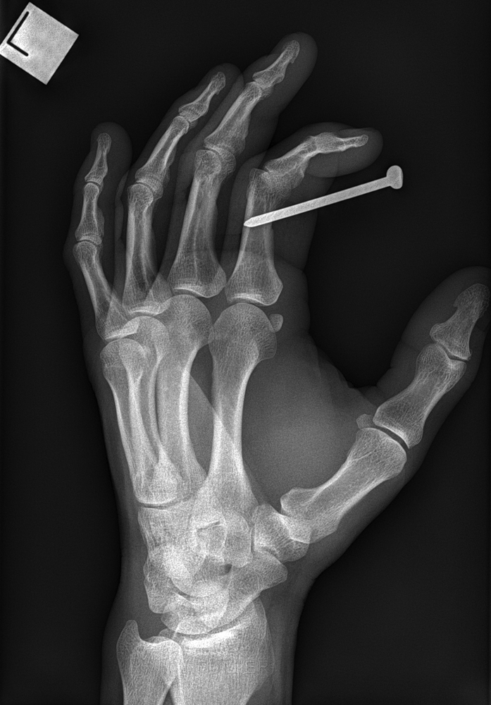 nail gun finger