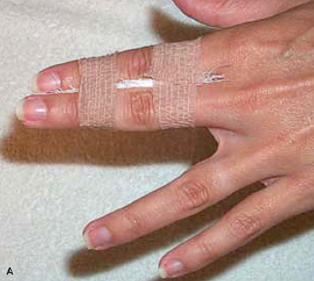 BUDDY TAPING OF FINGERS