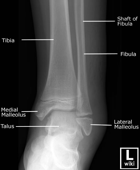 Radiographic Anatomy - Ankle - AP
