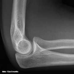 Normal Elbow. Male. 17years, 8 months