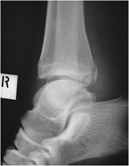ankle fracture