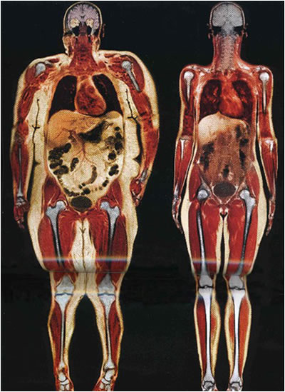 Effects of Being Morbidly Obese - wikiRadiography