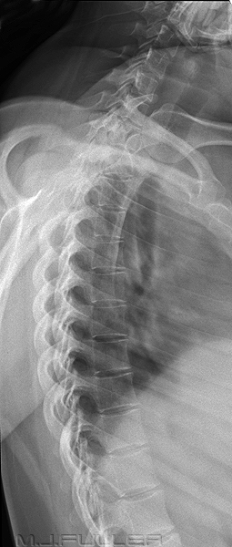 Lateral Thoracic Spine Special Technique - wikiRadiography