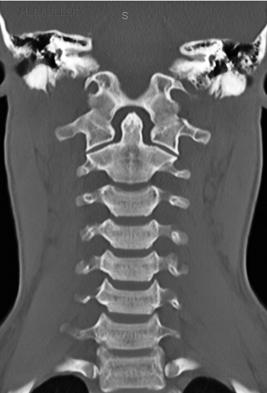 CT cervical spine