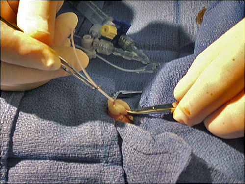 Umbilical Catheter Insertion