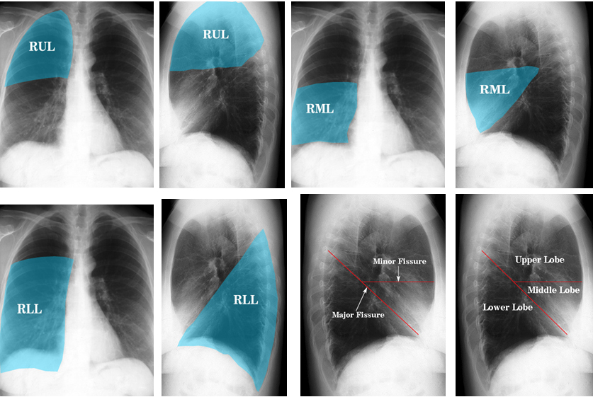 Lung Anatomy - wikiRadiography