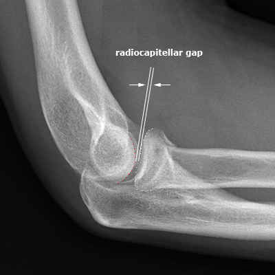 lateral elbow- radiocapitellar gap