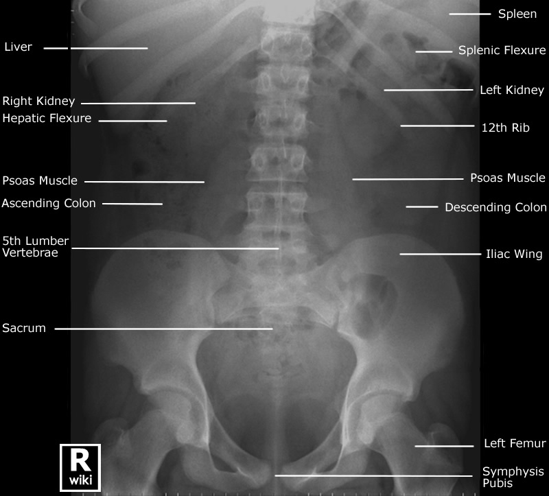 Radiographic Anatomy - Abdomen AP Supine