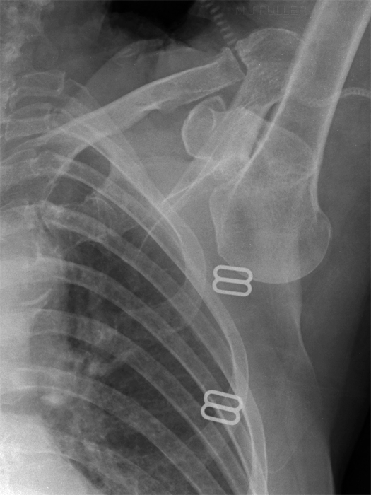 AP shoulder dislocation