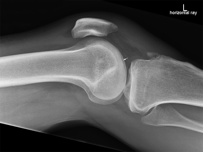 lateral knee