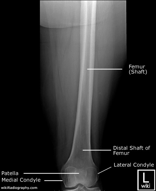 Radiographic Anatomy - Femur - AP - Distal