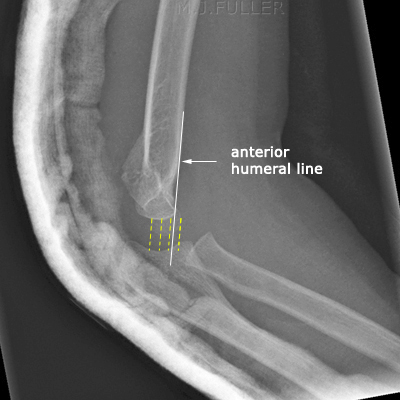 anterior humeral line