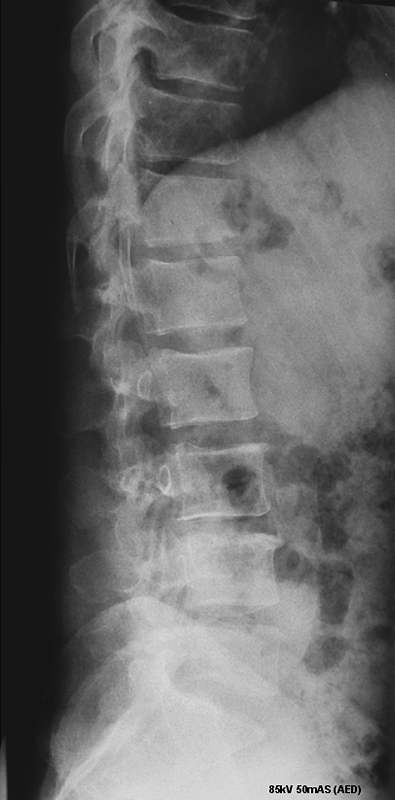Lateral Lumbar Spine Breathing Technique - wikiRadiography