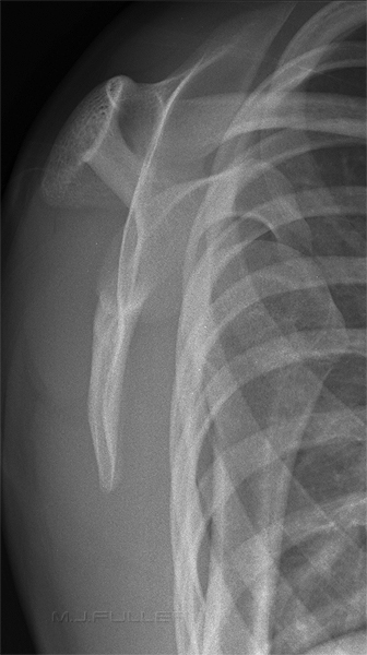 Lateral scapula