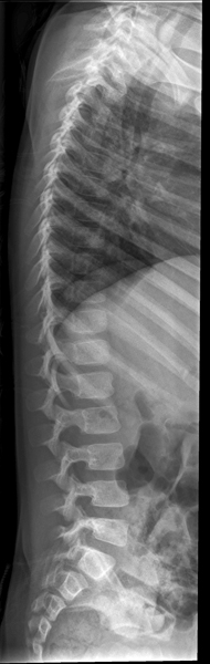 thoracic lumbar spine