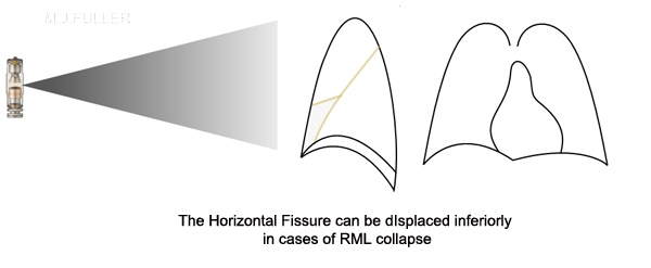 horizontal fissure in RML collapse