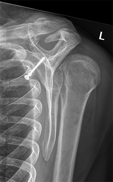 posterior shoulder dislocation