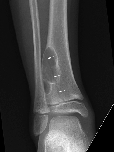 pathological fracture