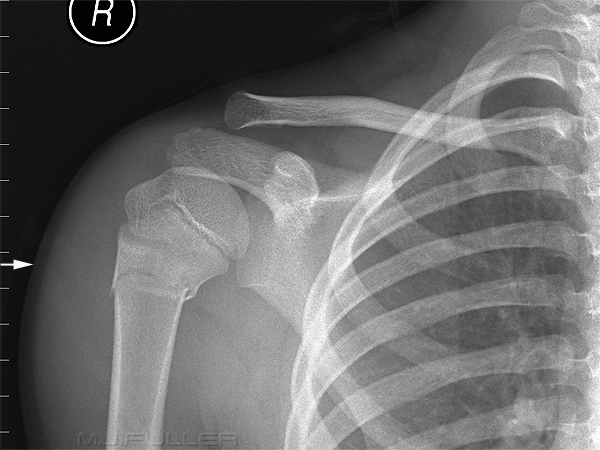 neck of humerus fracture